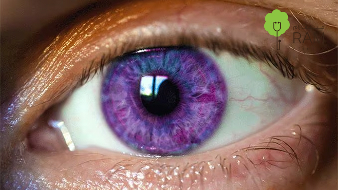 متلازمة الإسكندرية