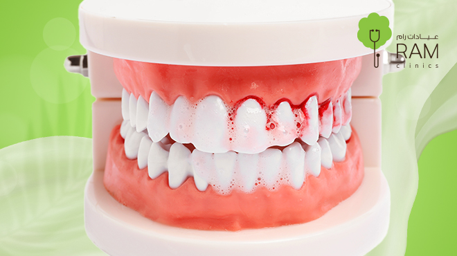 نزيف اللثة ليلًا