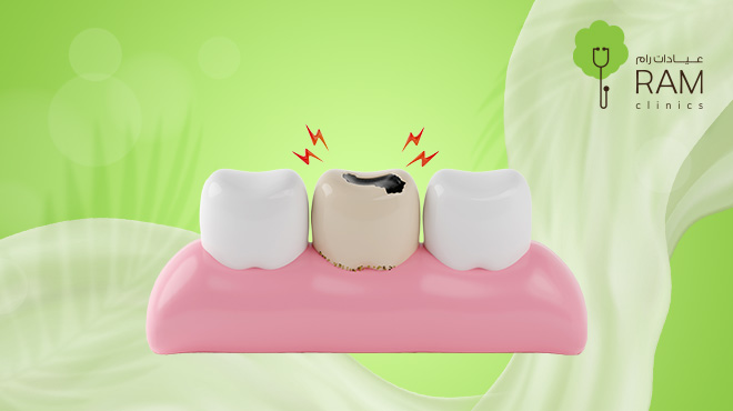 تسوس-الأسنان