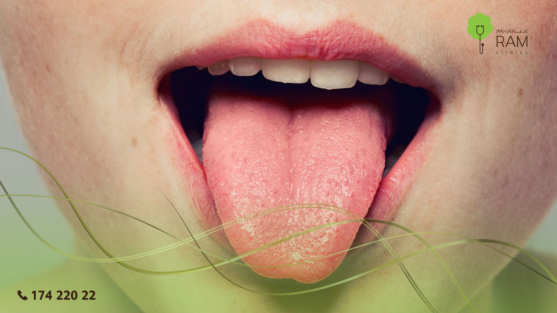 فطريات اللسان