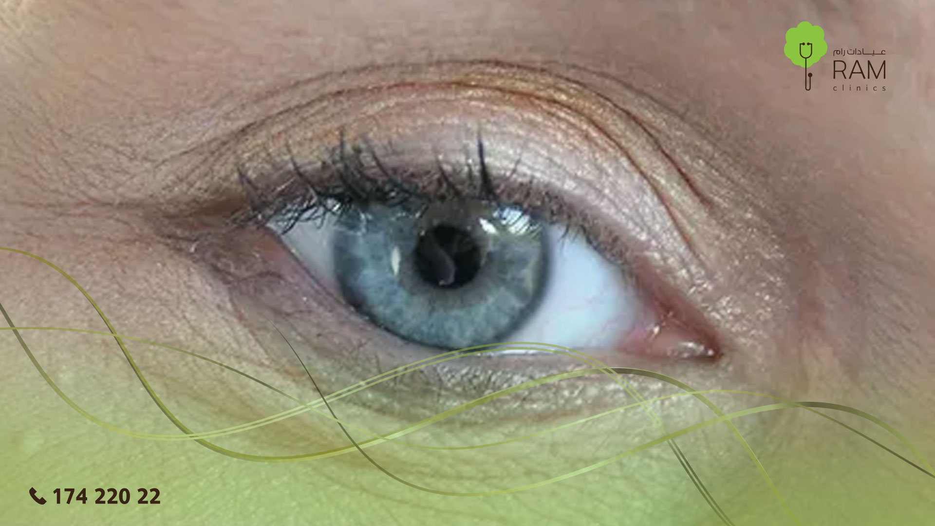 ترهل الجفن العلوي