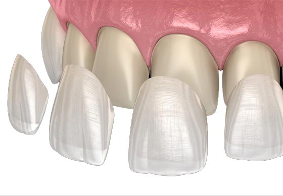 كل ما يخص تركيبات أسنان البورسلين&nbsp;