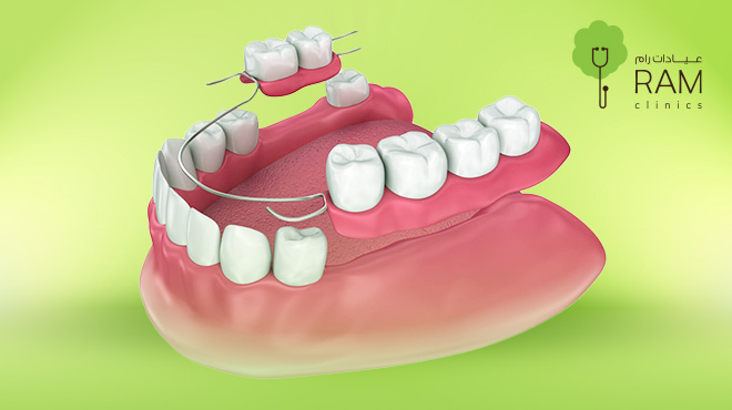 ما هي تركيبات الأسنان المؤقتة