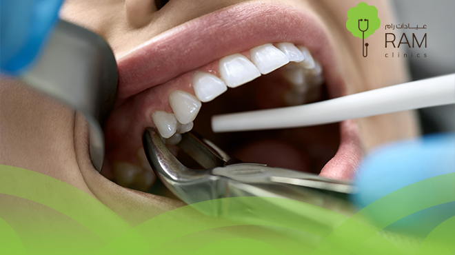 كيف تتعامل بعد خلع الضرس