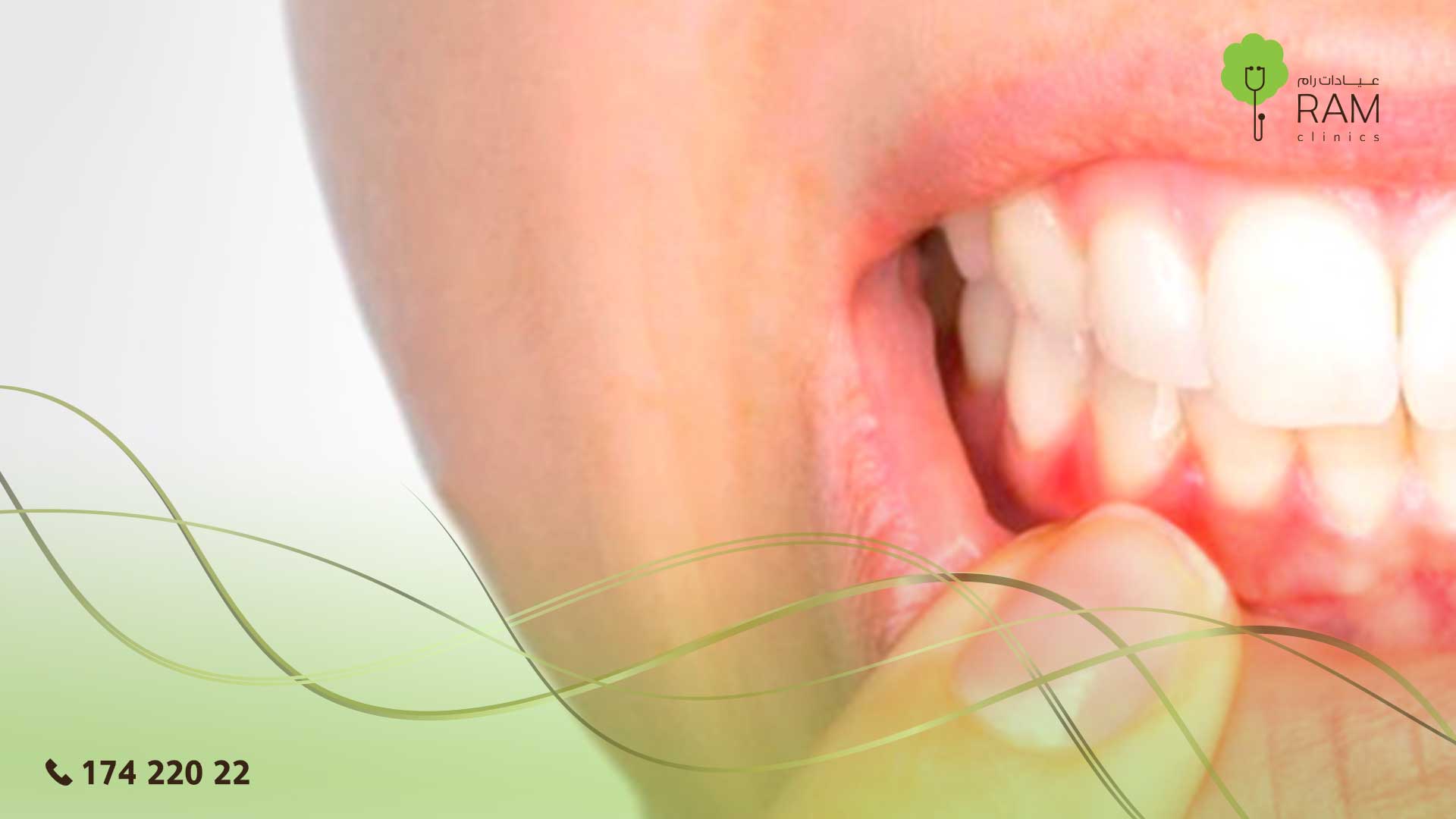 ِالتهاب اللثة