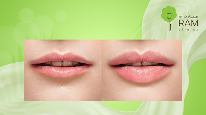 انواع-فيلر-الشفايف