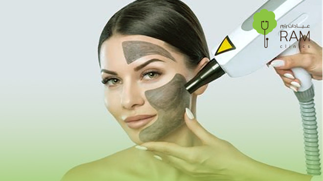 الليزر الكربوني للوجه… مظهر شبابي يدوم