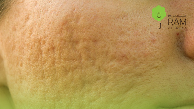 جلسة-تقطيع-الألياف