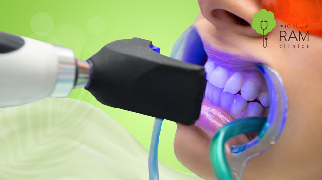 تبييض الأسنان بالليزر