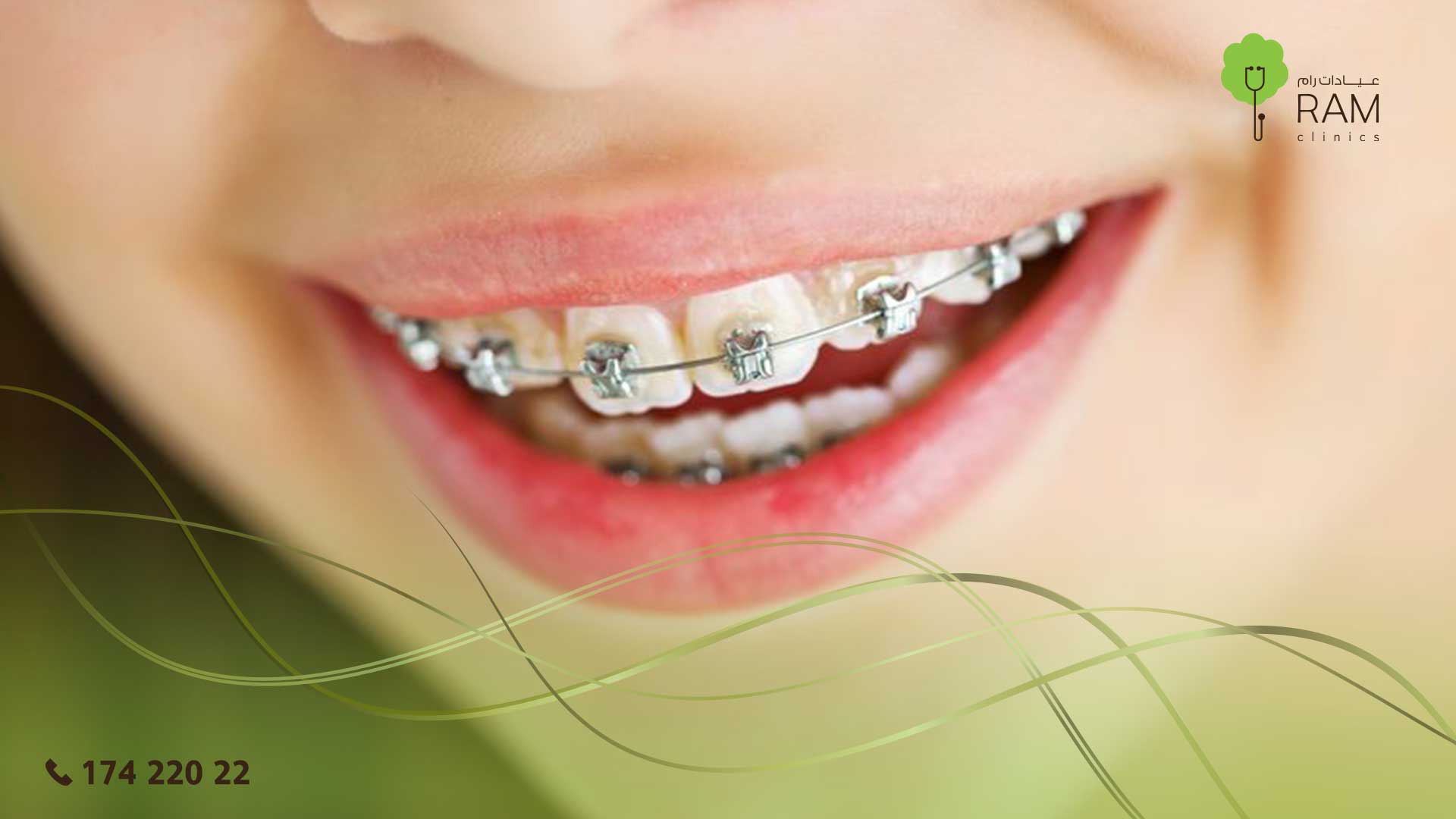 تقويم الأسنان