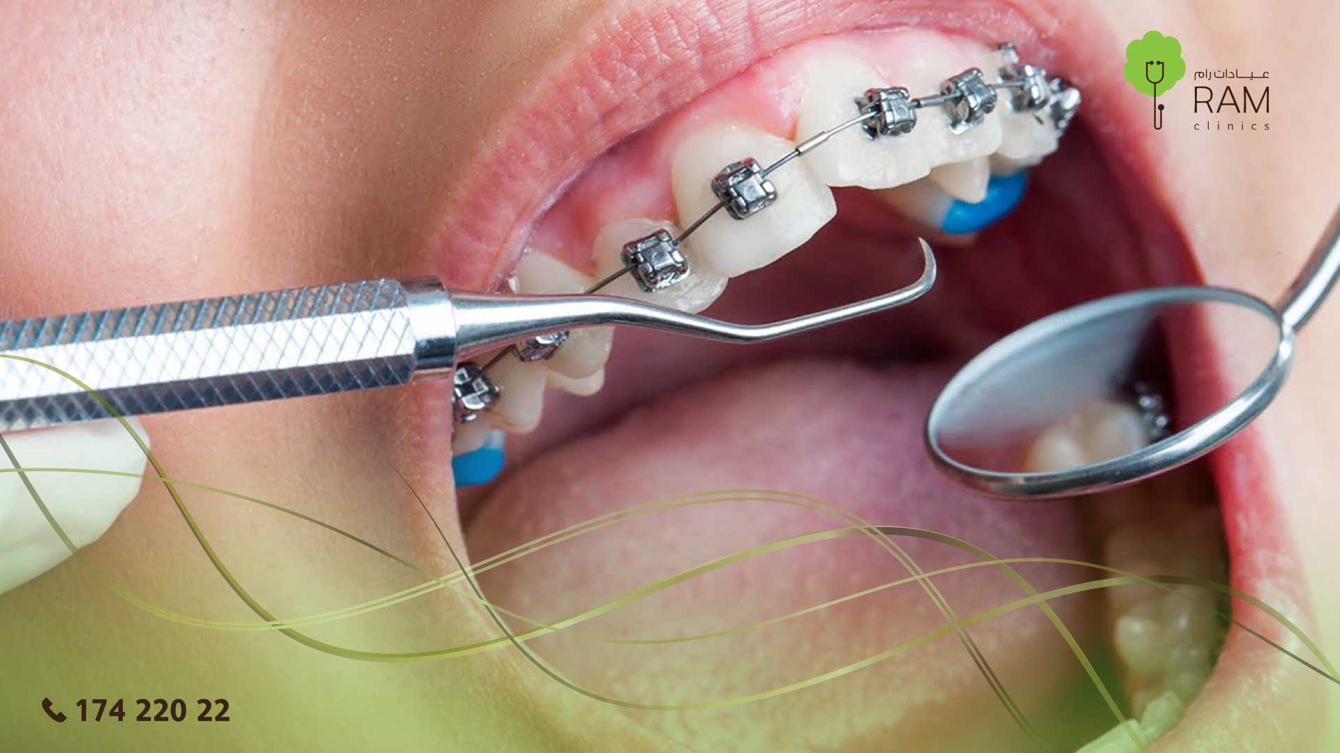 تقويم الأسنان التجميلي